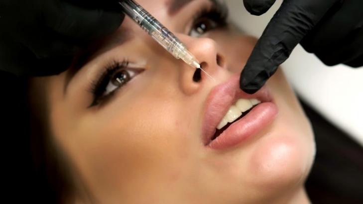 Injection d'acide hyaluronique pour sublimer des lèvres